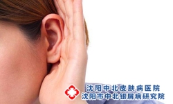 耳朵后面放血能治牛皮癣是好的偏方吗?
