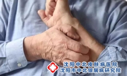 沈阳哪个医院治疗皮肤病比较好：哪些坏习惯会引起牛皮癣?