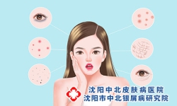 脸部牛皮癣什么可以抑制