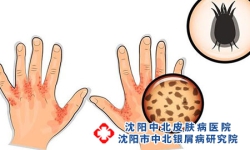 牛皮癣临床分4型 牛皮癣的症状