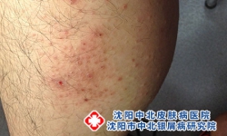 湿疹：典型特征分型与成因及日常防护