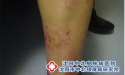 近期寻常型银屑病会加重吗？医师指导：实用方法分享