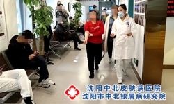 如何护理牛皮癣介绍7个护理方法