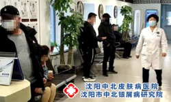 沈阳治牛皮癣哪家医院好-运动可以治疗牛皮癣？