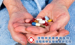 西医治疗牛皮癣介绍 治疗牛皮癣用什么药