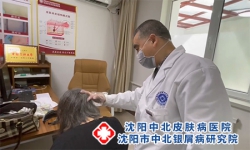 沈阳哪个银屑病医院好-牛皮癣常见的并发症