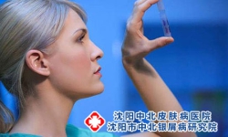 夏季关节型银屑病的护理要点