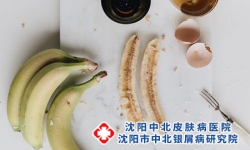得了牛皮癣吃香蕉好吗？