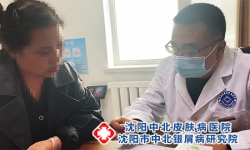 沈阳牛皮癣医院：牛皮癣可以喝红茶水吗?