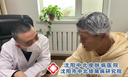 沈阳哪家看银屑病好？