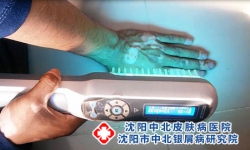 沈阳中北医院皮肤科银屑病治疗全攻略，不容错过!