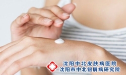 夏季关节型牛皮癣科学护理的关键点