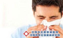 怎么治疗男性牛皮癣?