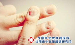 牛皮癣验血能确诊吗 得了牛皮癣怎么办