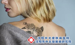 纹身会引起牛皮癣加重吗？