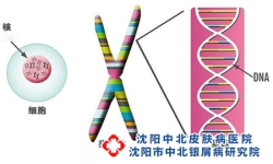 导致牛皮癣的发病原因有哪些?