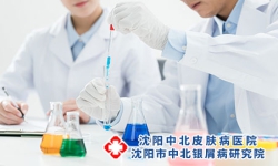 早日解决牛皮癣带来的困扰 牛皮癣怎么护理好