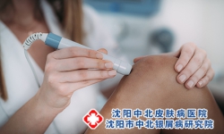 如何摆脱治牛皮癣中一些误区 牛皮癣的治疗方法