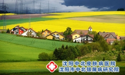 沈阳牛皮癣患者可以染发、烫发吗