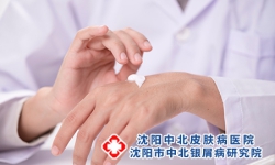 讲解牛皮癣的症状都有哪些