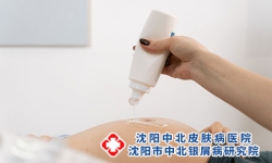 荷尔蒙与银屑病关系解析，了解影响因素!沈阳银屑病医院