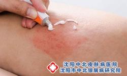 治疗大厚斑块的银屑病需要考虑哪些?