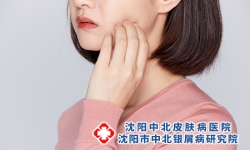 脸上银屑病怎么预防治疗?