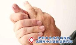 手上长牛皮癣有哪些注意事项?