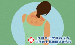 牛皮癣的症状是什么? 牛皮癣的治疗