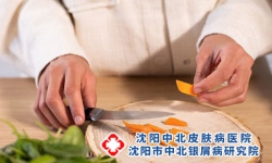 银屑病患者日常营养要均衡!专家教你正确忌口，合理饮食!