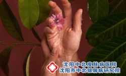 牛皮癣的皮屑要怎么护理