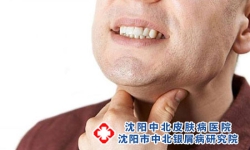 不要踏入牛皮癣的用药误区