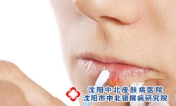 青少年银屑病患者春季如何护理