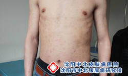 轻度银屑病做汗蒸会好转吗 温热护理认知实用指南