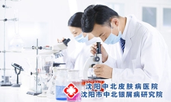 牛皮癣会危及生命吗 及时诊治方能缓解牛皮癣症状