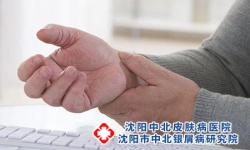 寻常型牛皮癣症状分型及危害