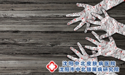 为什么有人误解牛皮癣会传染