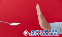 “盐”多必失!银屑病患者该如何正确控制盐的摄入?