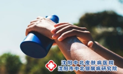 沈阳治银屑病哪家好前三银屑病患者夏季为什么要注意防晒