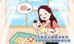 银屑病会通过母乳传染给宝宝吗?