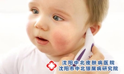 遗传性牛皮癣是否能治好