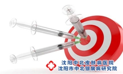 牛皮癣康复后仍需巩固治疗
