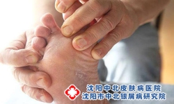牛皮癣的主要病因分析 牛皮癣的危害有哪些呢