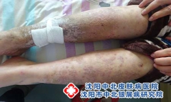 老年人群中常见的银屑病类型有哪些?