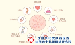沈阳牛皮癣复发有哪些症状表现呢