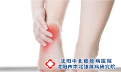 红皮型牛皮癣夏季护理技巧