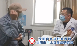 皮肤病湿疹用什么药膏 湿疹外用药选择实用指南