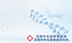 沈阳银屑病抗组胺药物止痒效果吗