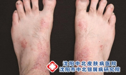 皮炎：科学认知与日常防护指南