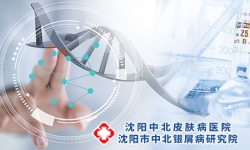 如何正确对待和治疗牛皮癣呢 牛皮癣怎么办
